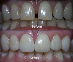 Before:After Veneers